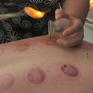 fire cupping