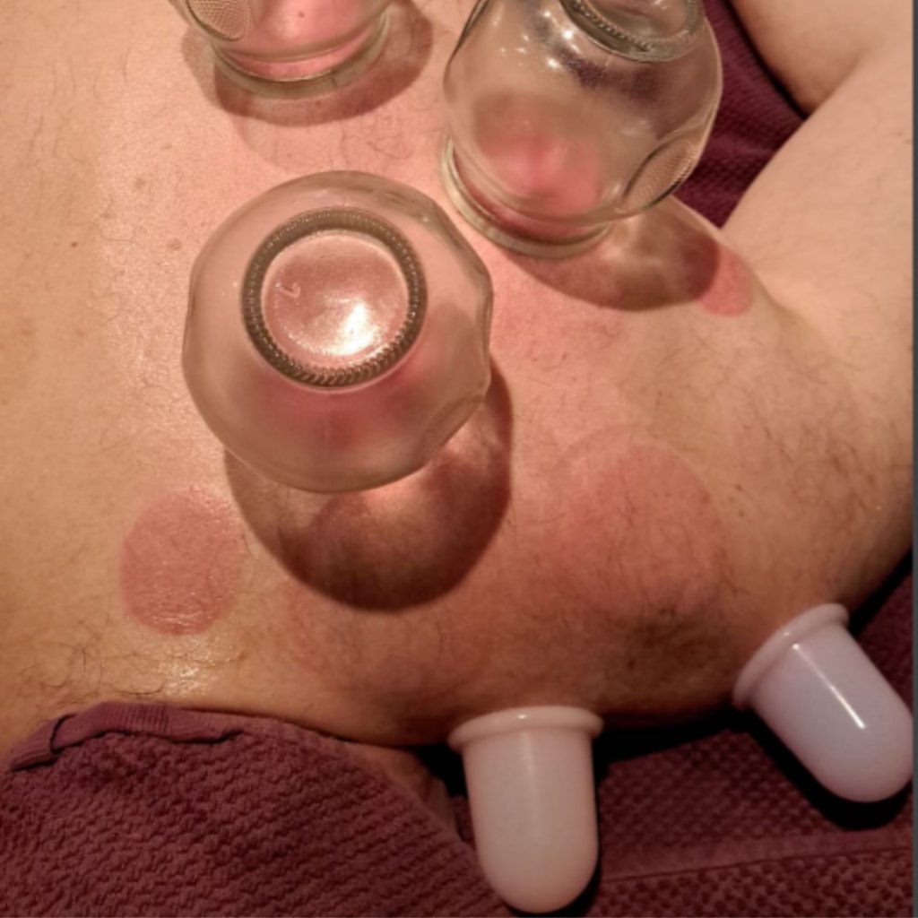 cupping